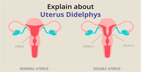 2 vaginas photo|Two Vaginas: Expert Insights on Uterine Didelphys .